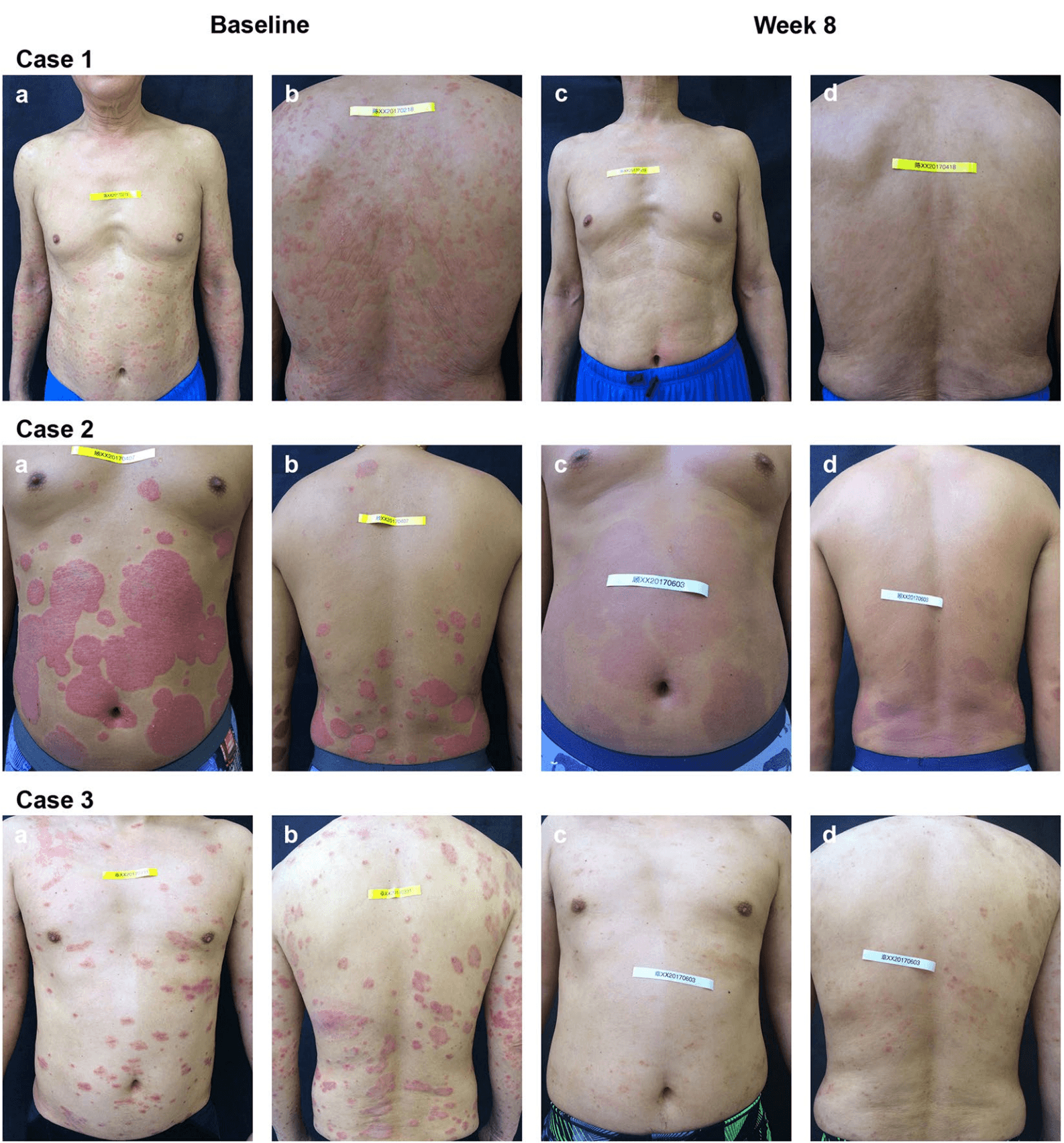 Psoriasis-Patienten vor und nach 8 Wochen Wasserstoff-Bad — Zhu et al. 2018